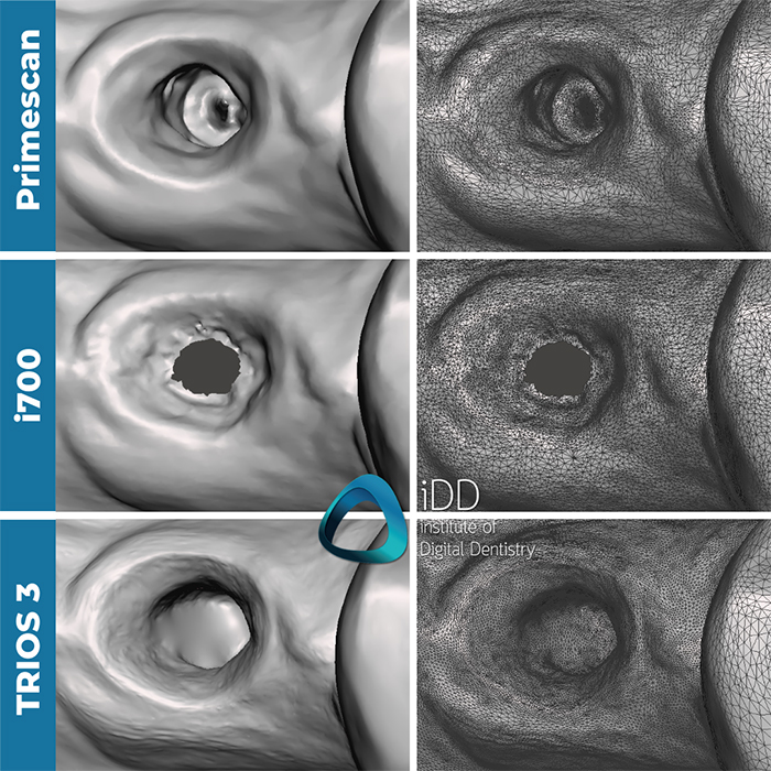implant-scan-with-trios-medit-cerec-institute-of-digital-dentsitry (5)