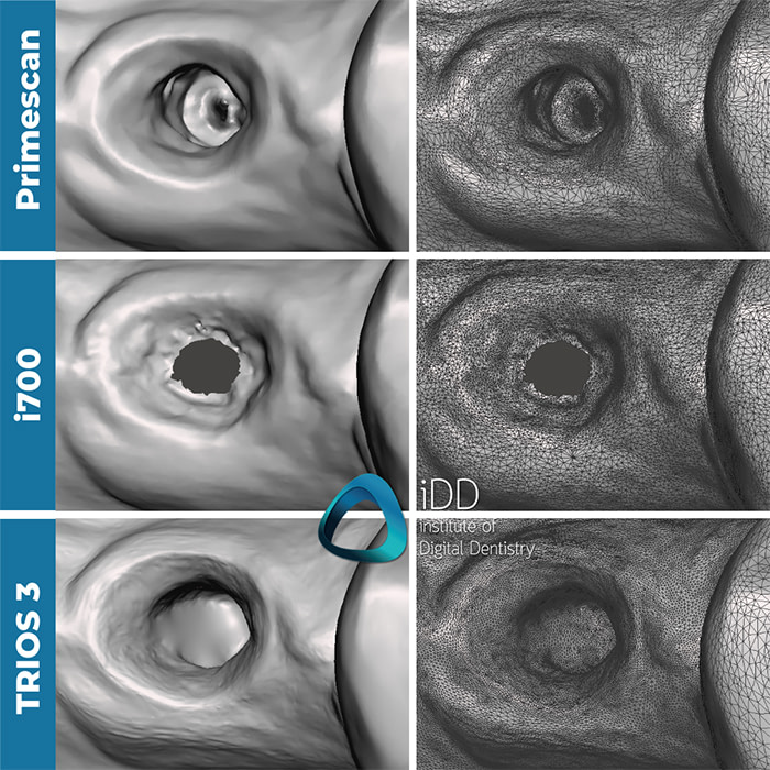implant-scan-with-trios-medit-cerec-institute-of-digital-dentsitry (5)
