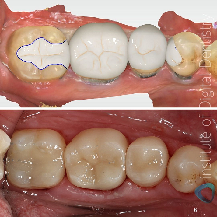 CEREC-Inlay-Crowns-Glazing-Polishing-Ahmad-AlHassiny-iDD