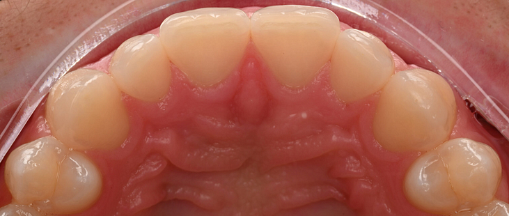 3shape-intraoral-trios-scan-bite-splint-idd-institute-of-digital-dentistry-blog-byron-park-patient-palatal-zoom-incisors