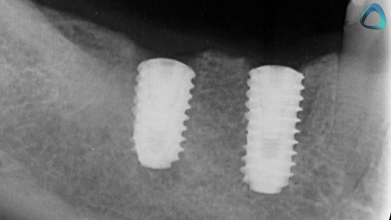 x-guide-post-surgical-photo