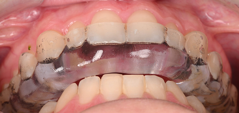 3shape-intraoral-trios-scan-bite-splint-idd-institute-of-digital-dentistry-blog-byron-park-final-splint-try-in-thickness