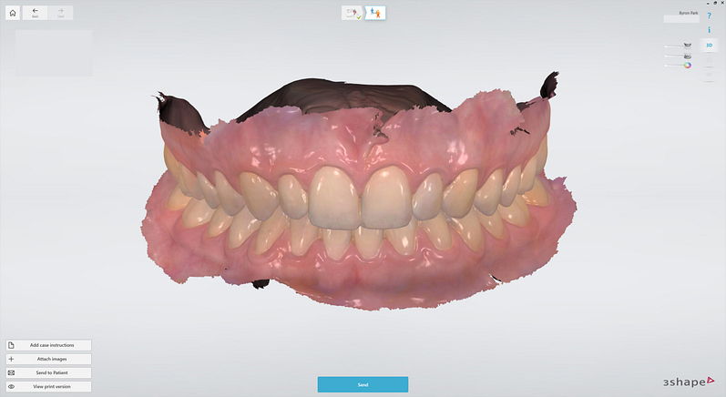 3shape-intraoral-trios-scan-bite-splint-idd-institute-of-digital-dentistry-blog-byron-park-patient-intraoral-scan-bite-full-mouth