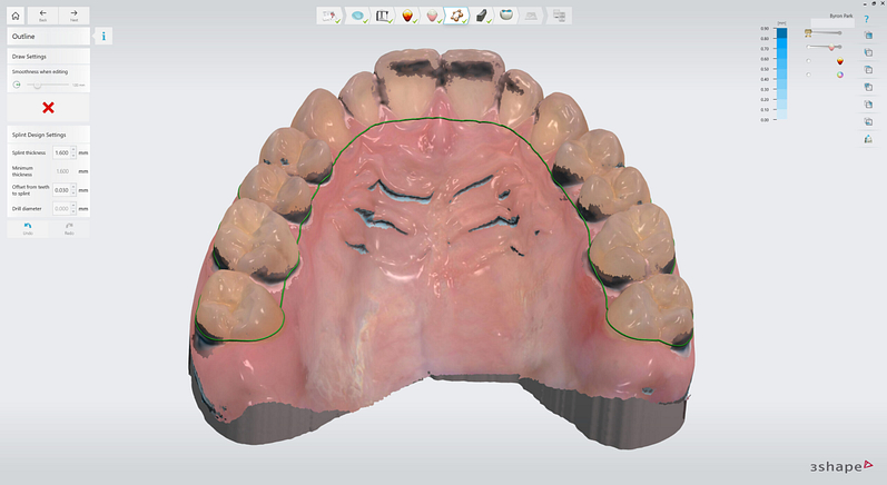 3shape-intraoral-trios-scan-bite-splint-idd-institute-of-digital-dentistry-blog-byron-park-splint-studio-splint-outline-fast-edit