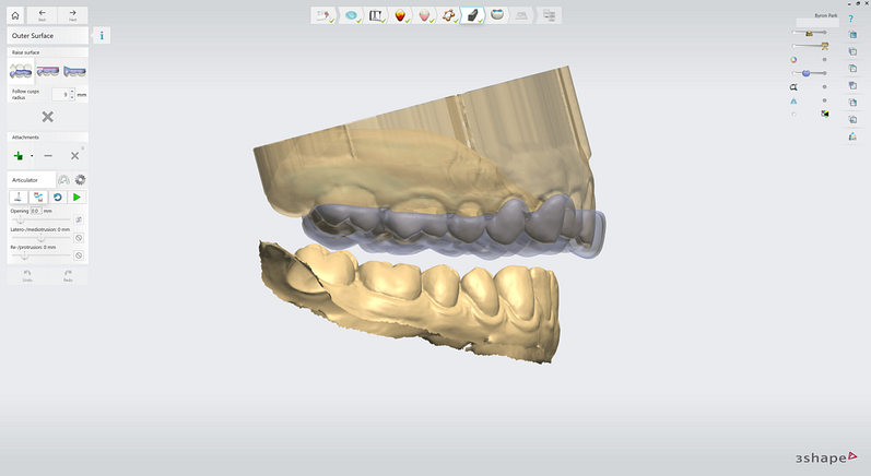 3shape-intraoral-trios-scan-bite-splint-idd-institute-of-digital-dentistry-blog-byron-park-splint-studio-splint-uniform-thickness