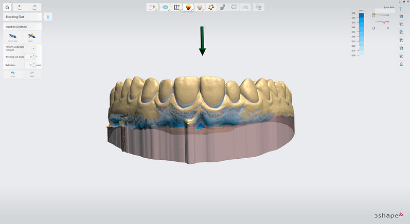 3shape-intraoral-trios-scan-bite-splint-idd-institute-of-digital-dentistry-blog-byron-park-splint-studio-undercut-removal-block-model