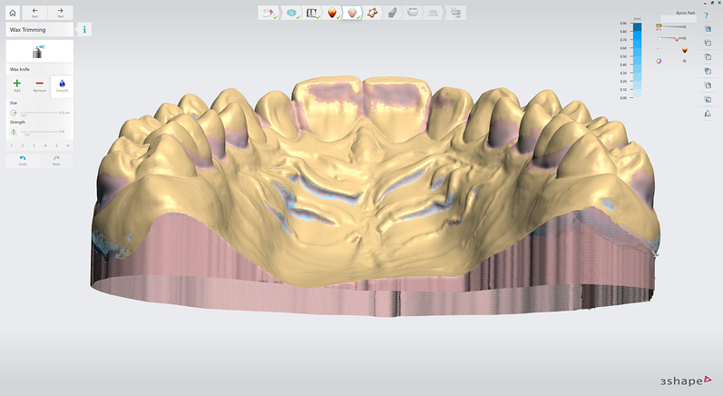 3shape-intraoral-trios-scan-bite-splint-idd-institute-of-digital-dentistry-blog-byron-park-splint-studio-wax-trimming