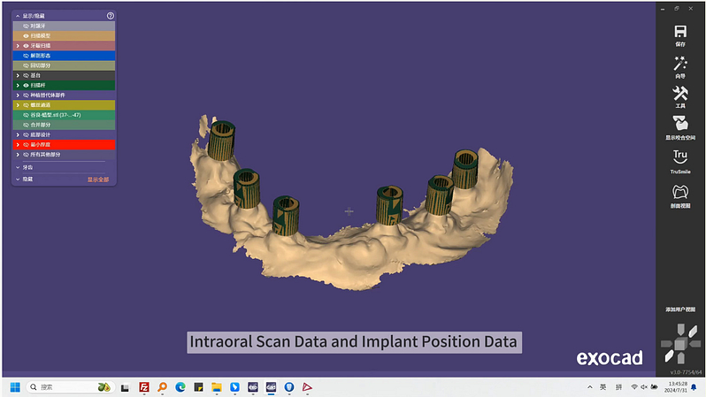 shining-3d-dental-aoralscan-elite-intraoral-scanner-launch-idd-institute-of-digital-dentistry-blog-provisional-design