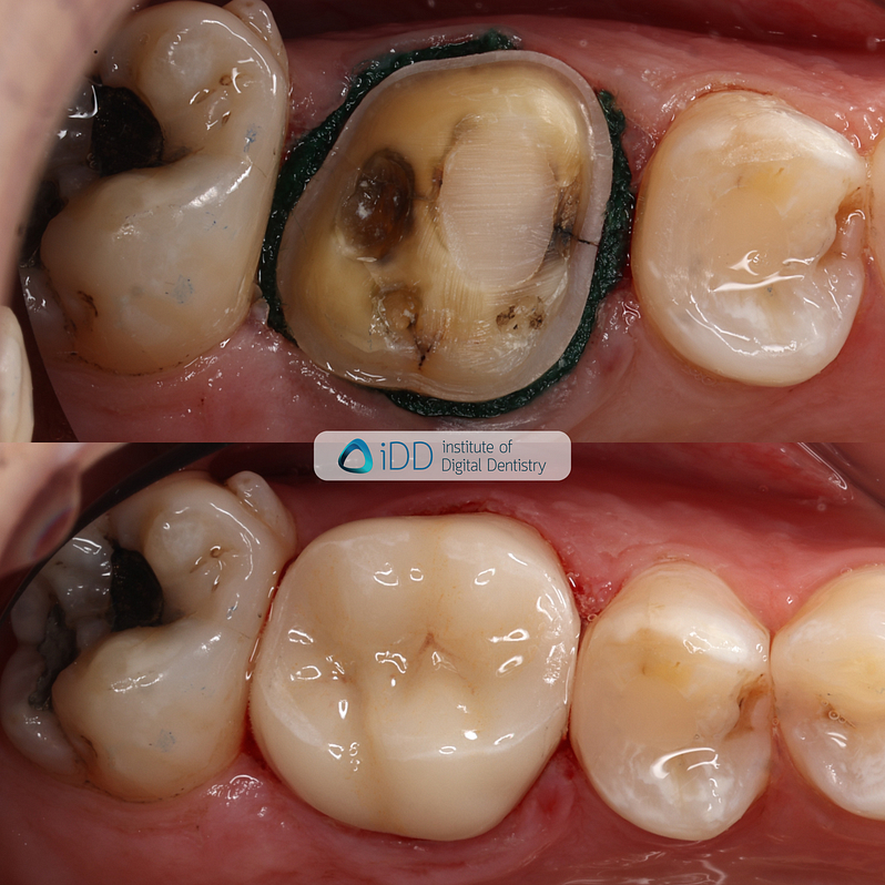 prep-image-final-restoration-photo-patient-idd-compares-institute-of-digital-dentistry-blog