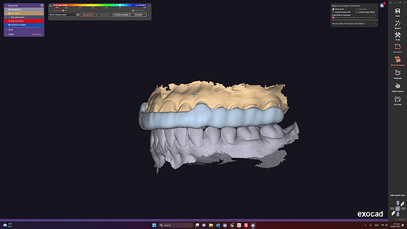 3d-print-dental-splints-nightguards-idd-exocad-splint-design