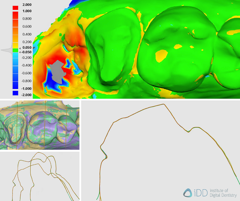 iDD-compares-color-deviation-3shape-intraoral-scanner-trios3-trios4-trios5 Deviation map of the scans as compared to TRIOS 5’s reference scan and sectional view.