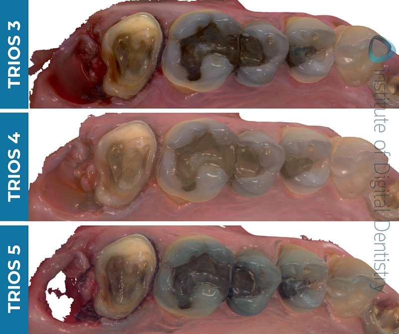 iDD-compares-color-scans-3shape-intraoral-scanner-trios3-trios4-trios5 iDD-compares-color-scans-3shape-intraoral-scanner-trios3-trios4-trios5