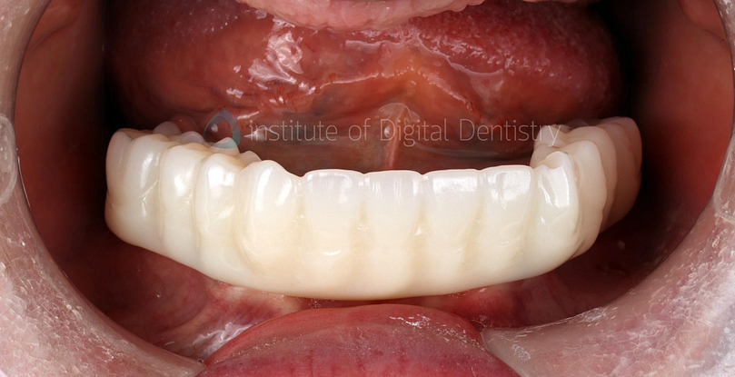 full_arch_printed_resto_shining3D_Elite_iDD