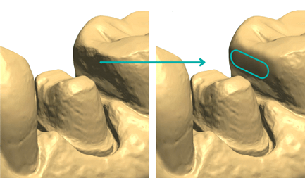 top five mistakes when scanning institute of digital dentistry (4)