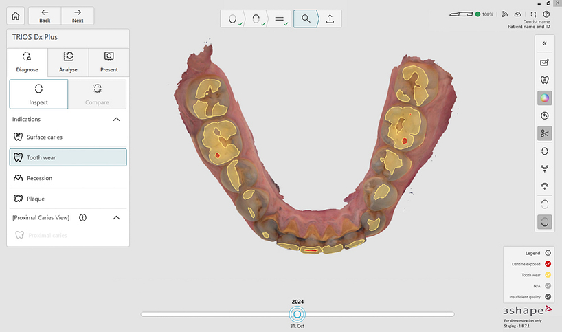 Dx Screenshots - DAY5_1425_ToothWearOcclusal