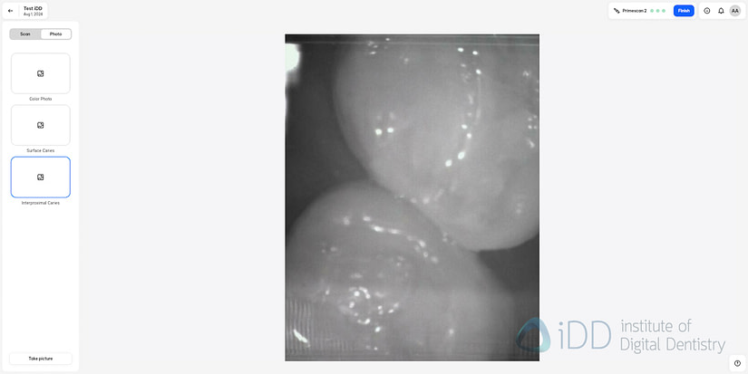 primescan_2_software_scan_caries2