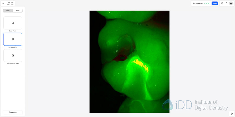 primescan_2_software_scan_caries3