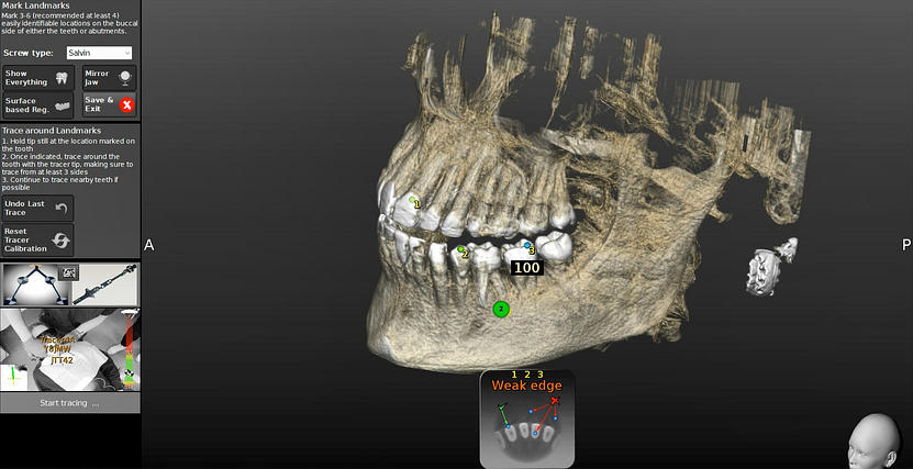 navident-evo-claronav-dynamic-navigation-idd-institute-of-digital-dentistry-dr-byron-park-first-impressions-cbct