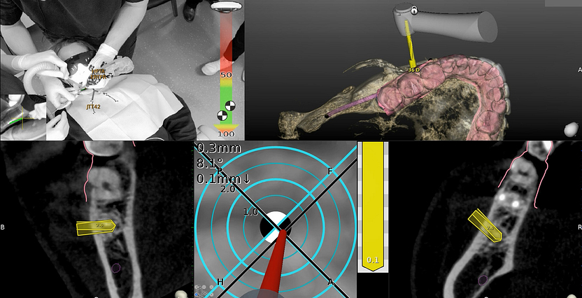 navident-evo-claronav-dynamic-navigation-idd-institute-of-digital-dentistry-dr-byron-park-first-impressions-live-navigation-drill-tip