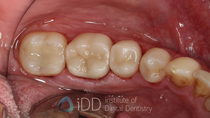 Fig-15-Matt-after-how-to-transition-into-digital-dentistry-workflows-watermarked