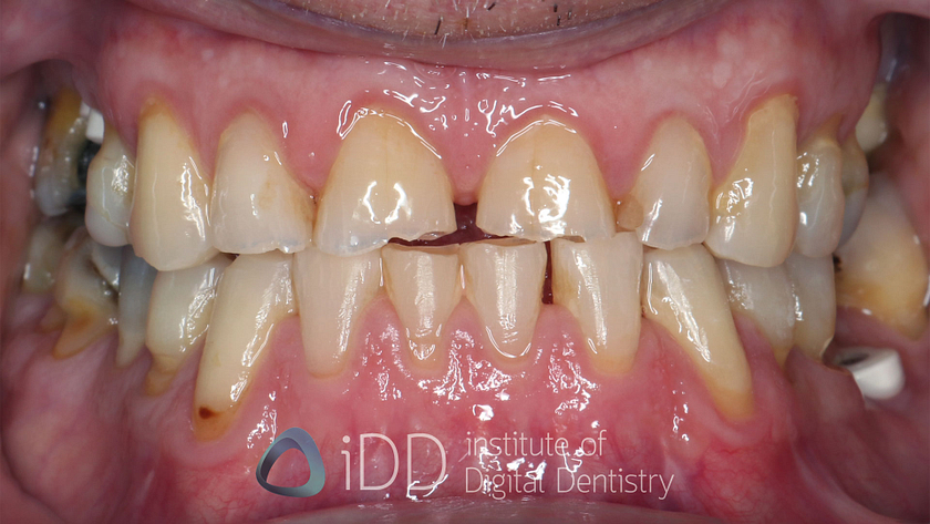 Fig-06-Peter-T-before-how-to-transition-into-digital-dentistry-workflows-watermarked