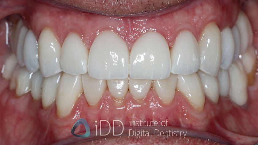 Fig-09-Peter-T-after-how-to-transition-into-digital-dentistry-workflows-watermarked