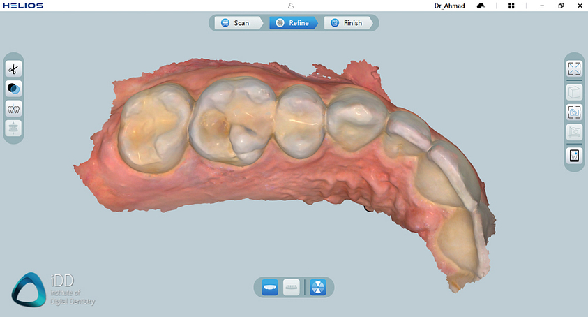helios 600 intraoral scanner review software overview institute of digital dentistry (19)