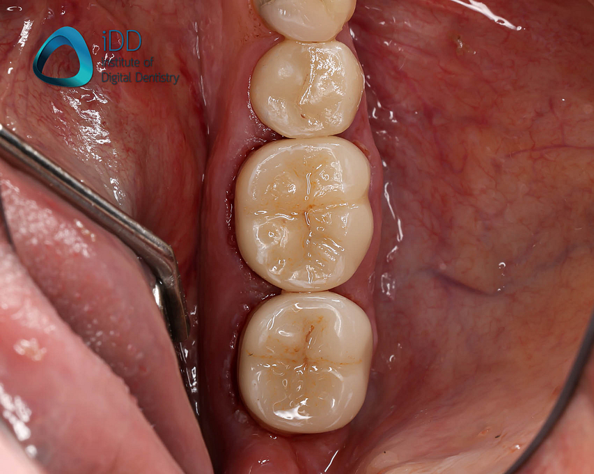 figure-11-post-operative-photo Figure 11. Post-operative photograph. The final ceramic crown restorations are bonded using resin cement.