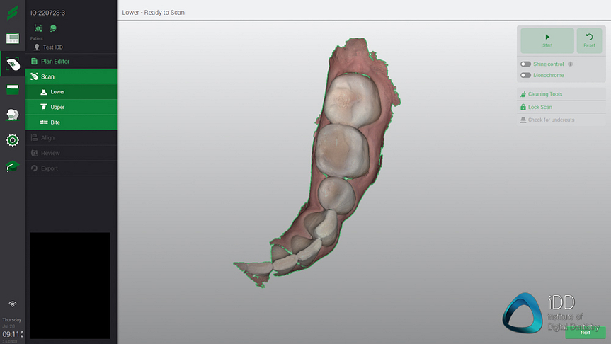 straumann virtuo vivo intraoral scanner review institute of digital dentistry (31)