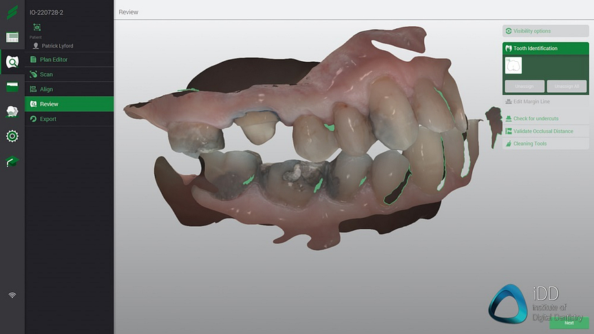 straumann virtuo vivo intraoral scanner review institute of digital dentistry (39)