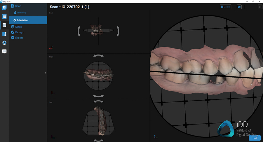 straumann virtuo vivo intraoral scanner review institute of digital dentistry (44)