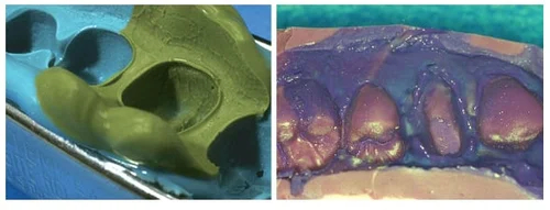 dental impressions common error 3