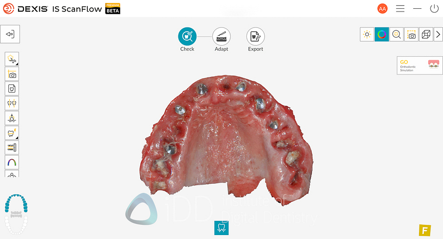 dexis_3800_wireless_intraoral_scanner_review_institute_of_Digital_dentistry15