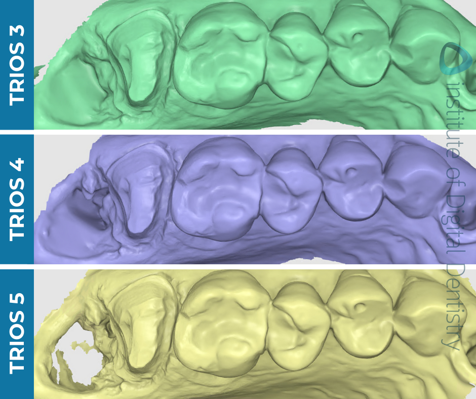iDD-compares-stl-medit-design-scans-3shape-intraoral-scanner-trios3-trios4-trios5 iDD-compares-stl-medit-design-scans-3shape-intraoral-scanner-trios3-trios4-trios5