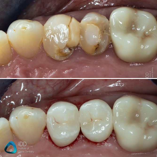 e.max ceramic restorations milled with primemill cerec same day crown (1)