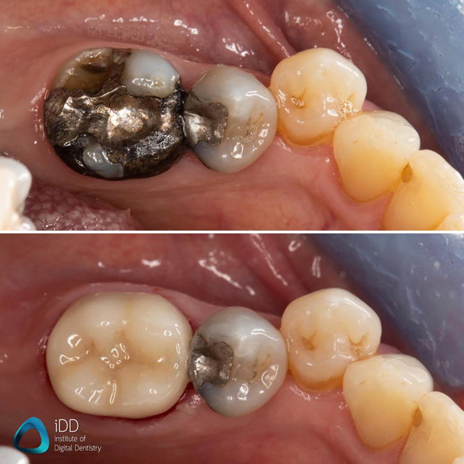 e.max ceramic restorations milled with primemill cerec same day crown (2)