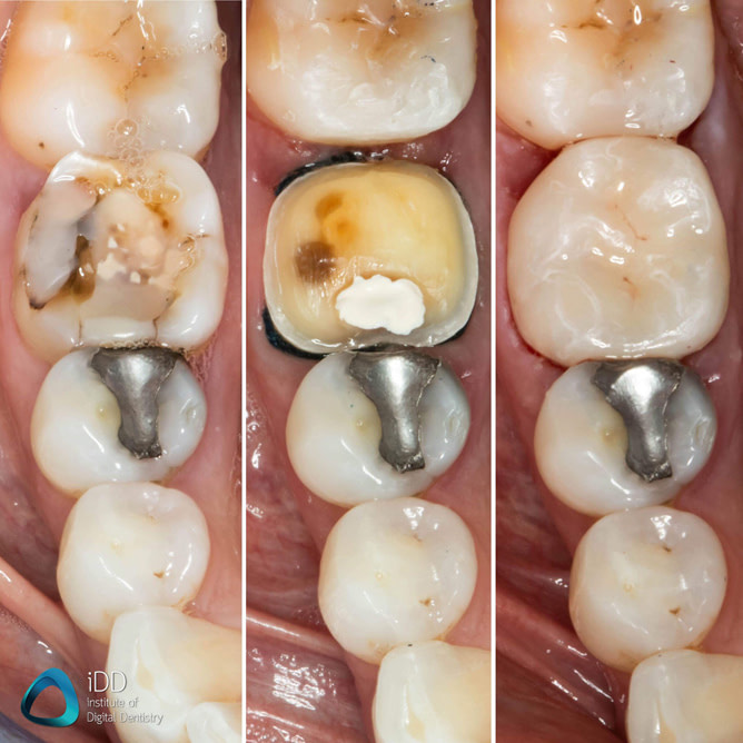 e.max ceramic restorations milled with primemill cerec same day crown (4)