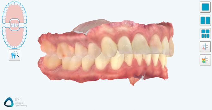 full arch scans itero element 5D plus