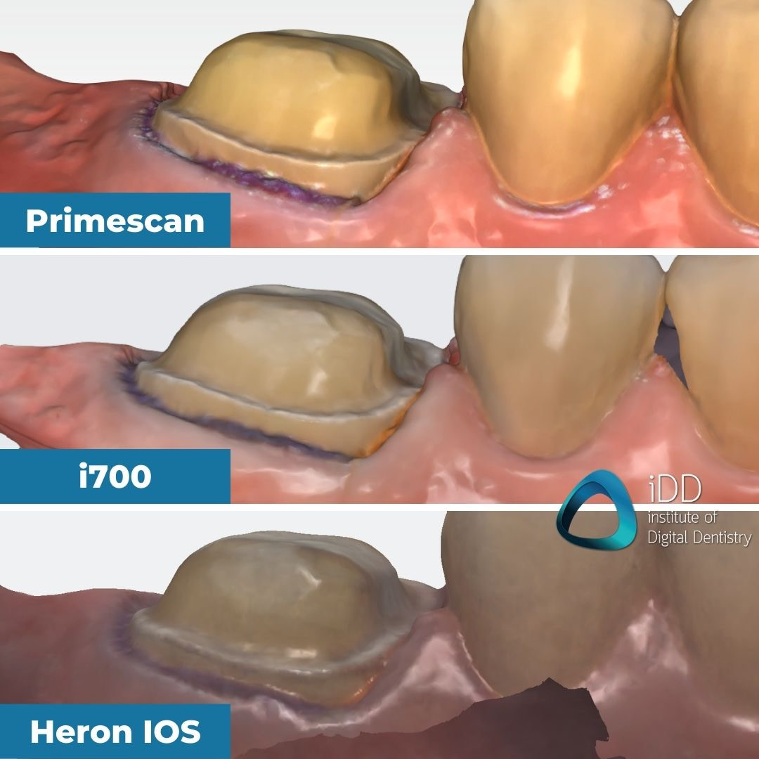 04-close-ups-of-the-mesial-buccal-margin-idd-compares-intraoral-scanners-expensive-vs-cheap-compared-cerec-primescan-vs-medit-i700-vs-heron-ios