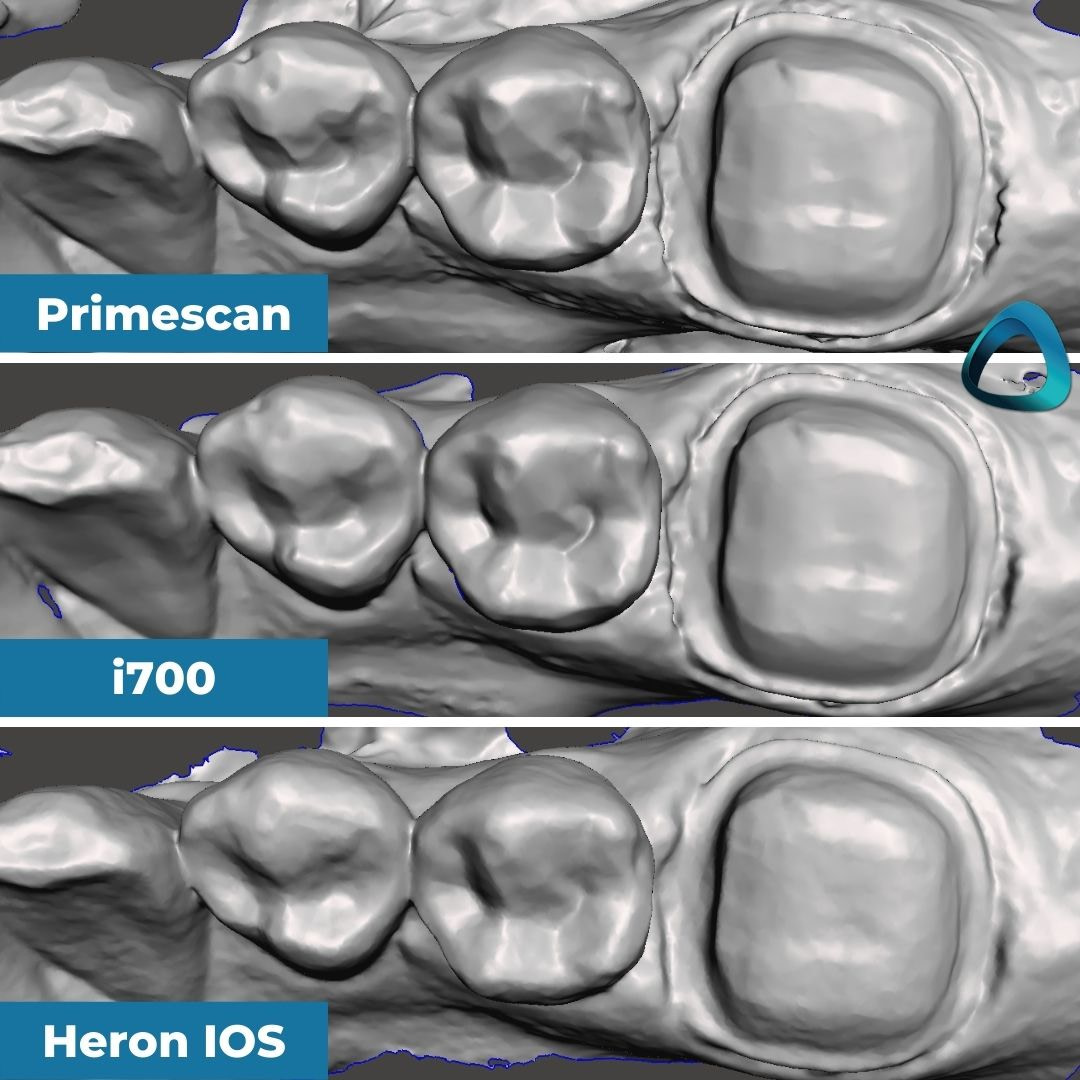 05-meshmixer-export-idd-compares-intraoral-scanners-expensive-vs-cheap-compared-cerec-primescan-vs-medit-i700-vs-heron-ios