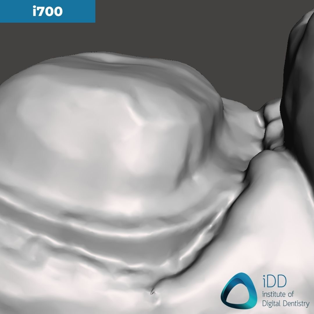09-medit-i700-close-up-of-the-margin-idd-compares-intraoral-scanners-expensive-vs-cheap-compared-cerec-primescan-vs-medit-i700-vs-heron-ios