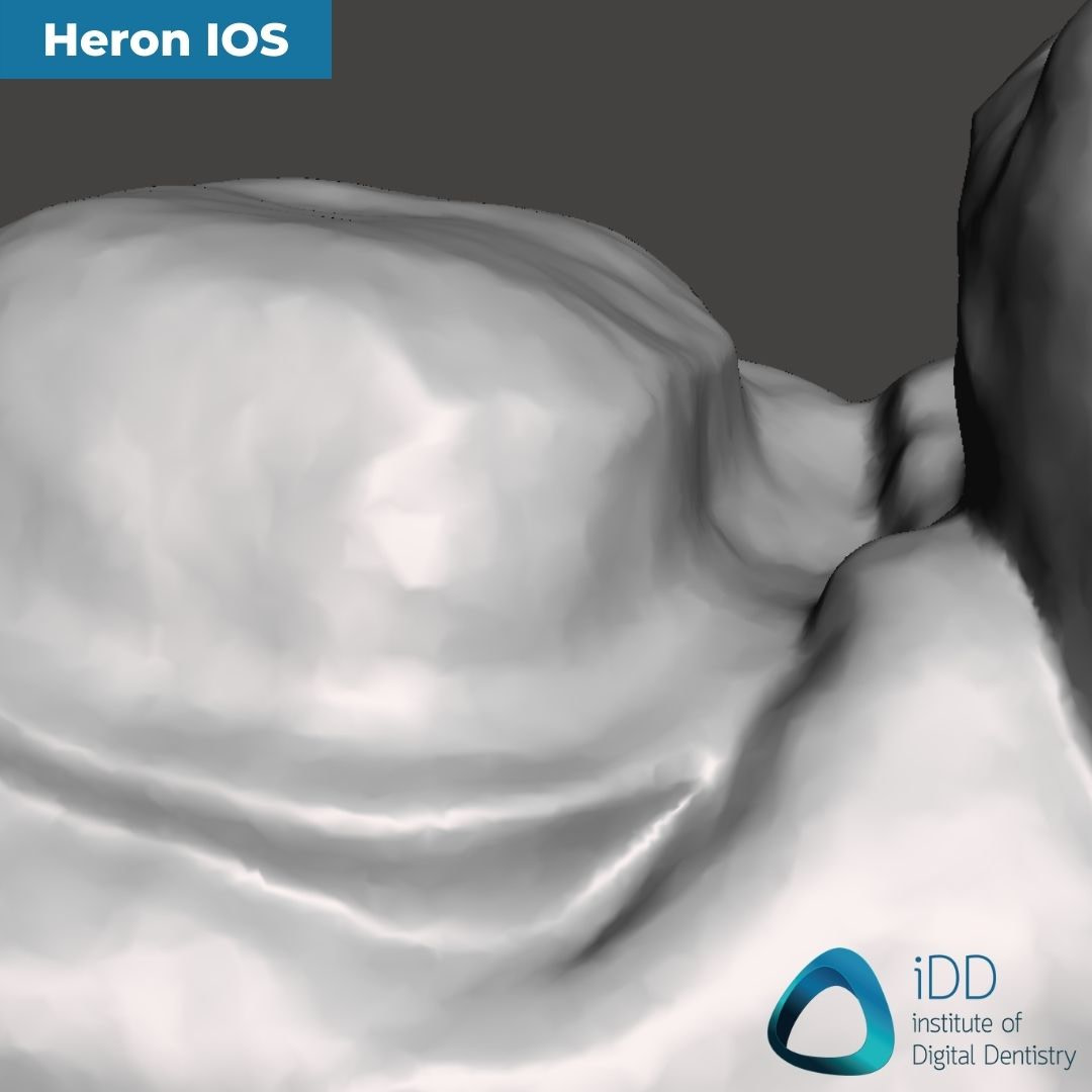 10-heron-ios-close-up-of-the-margin-idd-compares-intraoral-scanners-expensive-vs-cheap-compared-cerec-primescan-vs-medit-i700-vs-heron-ios
