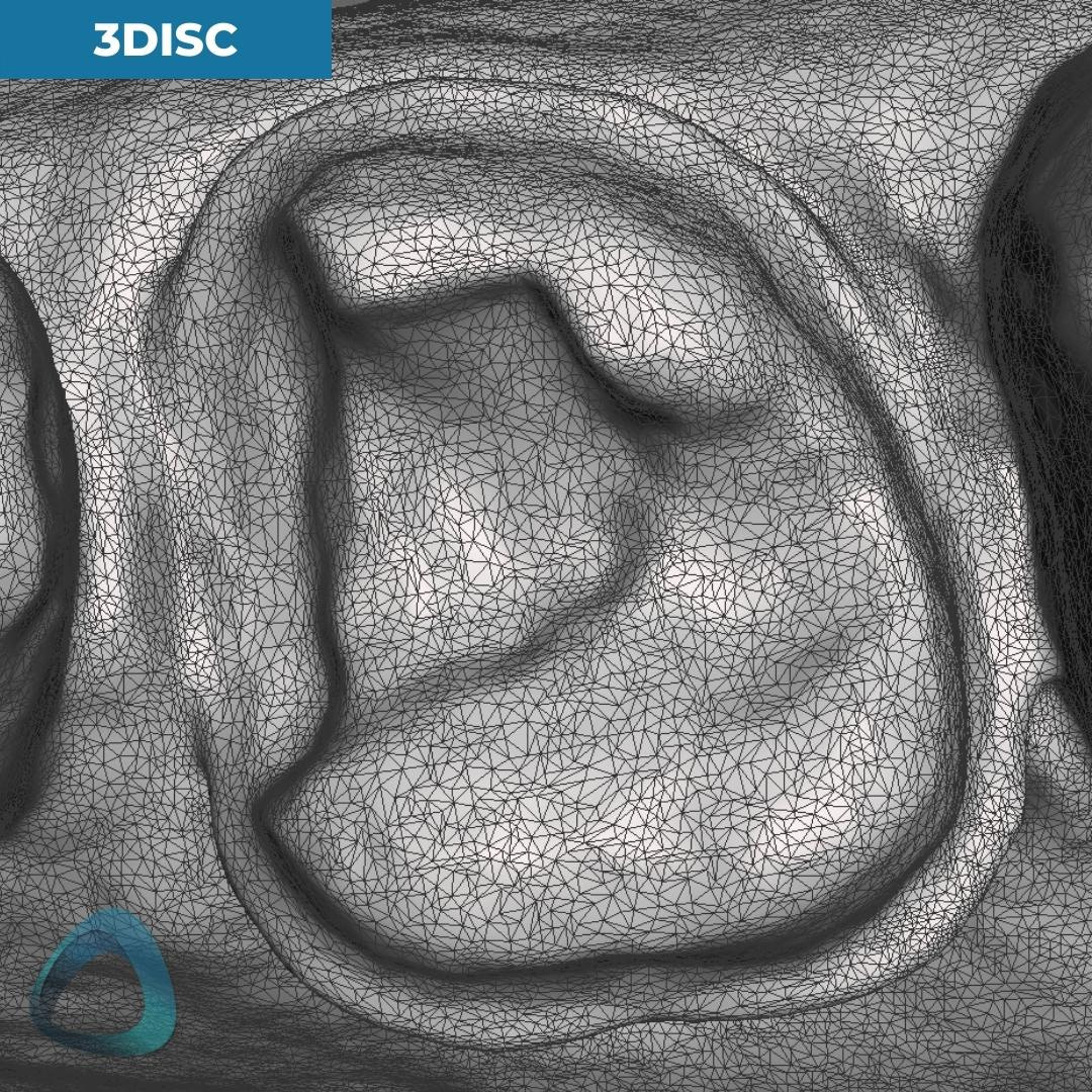 tooth-preparation-scan-with-3disc-heron-ios