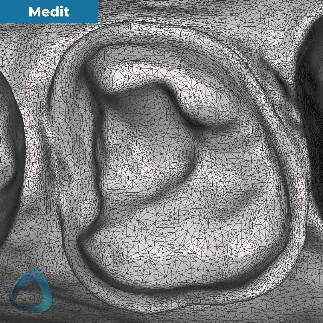 tooth-preparation-scan-with-medit-i700