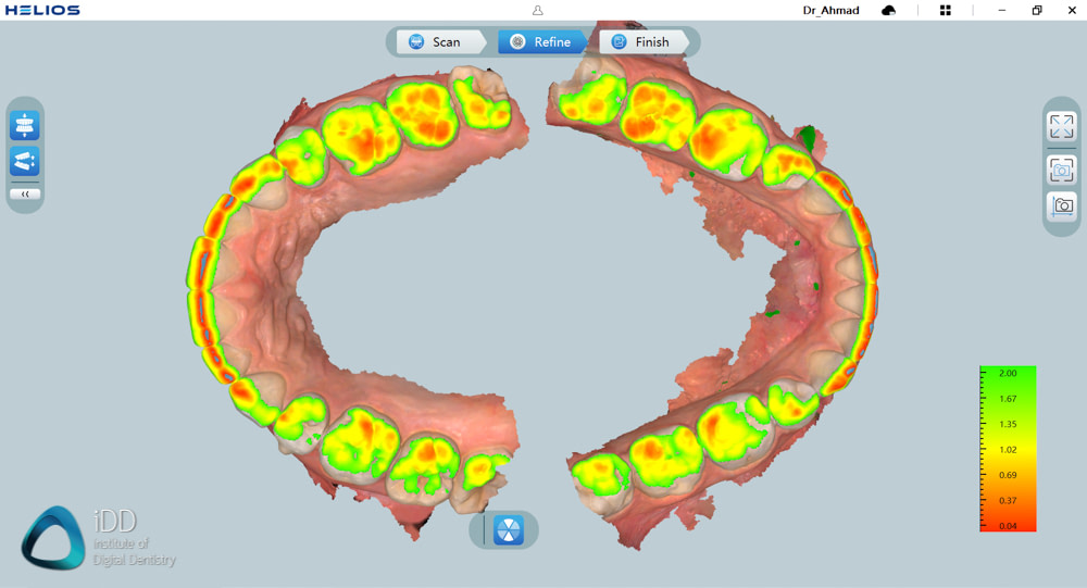 helios 600 intraoral scanner review software overview institute of digital dentistry (14)