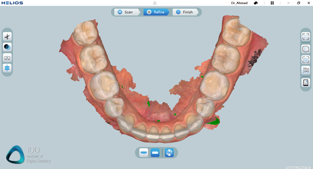 helios 600 intraoral scanner review software overview institute of digital dentistry (5)