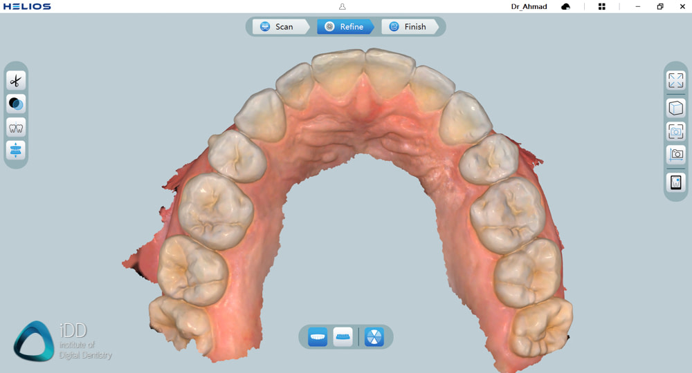 helios 600 intraoral scanner review software overview institute of digital dentistry (6)