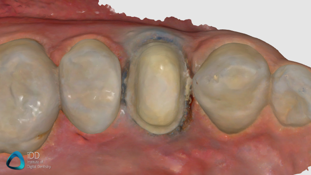 helios 600 medit i700 scans compare idd (1)