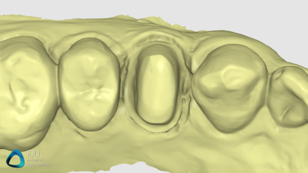 helios 600 medit i700 scans compare idd (4)