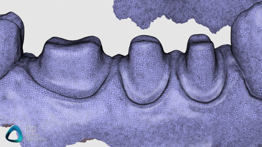 aoralscan 3 accuracy institute of digital dentistry (1)